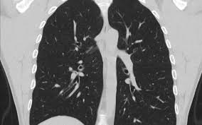 Fortunately, early detection of the cancer can drastically improve survival rates. Largest Ever Uk Lung Cancer Screening Study Aims To Improve Early Detection Ucl News Ucl University College London