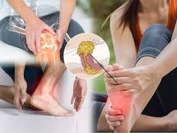 High Uric Acid Home Remedies: 7 Ayurvedic Herbs To Naturally Control Uric  Acid Levels and Reduce Joint Pain | TheHealthSite.com