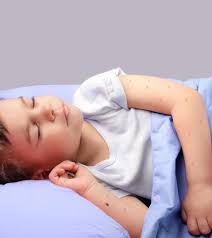 Another reported danger in extreme cases is. Bed Bug Bites On Kids Picture Causes Treatment Remedies