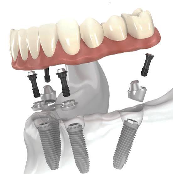 Teeth-in-a-Day™ | Waco, TX | Same-Day Dental Implants
