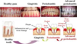 Image result for Gingivitis