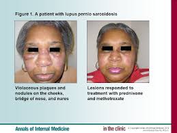Less commonly affected are the eyes, liver, heart, and brain. For Best Viewing Open In Slide Show Mode Click On Icon Or Ppt Download
