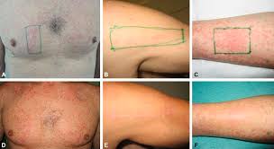 More than half of men who are. New Human Papillomavirus Hpv Types Involved In Epidermodysplasia Verruciformis Ev In 3 Hiv Infected Patients Response To Topical Cidofovir Journal Of The American Academy Of Dermatology