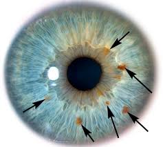 Image result for iridology