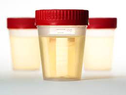Most people who have proteinuria won't notice any signs, especially in protein in urine treatment. Urine Protein Test Purpose Procedure And Preparation