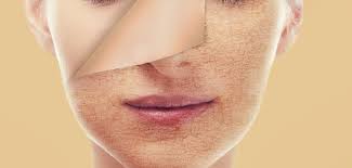 Penyebab bekas jerawat bopeng dan berlubang. Hilangkan Parut Jerawat Berlubang Kembali Sekata Dengan Bahan Semulajadi Cantikseri