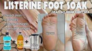 Baking soda has an alkaline property that helps to balance the ph level of the feet which creates an unfavorable environment for fungus and bacteria to survive. Listerine And Apple Cider Vinegar Foot Soak Demo Review Effective Ba Youtube