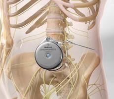 Image result for Intrathecal Pump