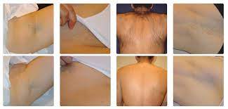 Once the back hair removal is complete, the sensation on your back is so much better when wearing clothes, sweating and after showering, says beautician sarah. Laser Hair Removal Laser Treatment Wandsworth London Sw1
