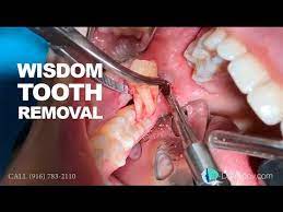 The fees for the extraction of all four wisdom teeth with dental insurance are between $190 and $994. Wisdom Tooth Removal In 5 Min Or Less Youtube