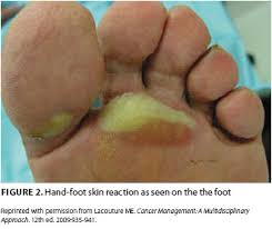 There are a variety of symptoms to be wary of—particularly for melanoma. Prevention And Management Of Hand Foot Syndromes Oncology Nurse Advisor