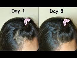 Regrow Hair From The Roots In Bald Patches Curry Leaves Hair Oil For Thick Hair Growth Long Hair Youtube Regrow Hair Grow Long Hair Thick Hair Styles