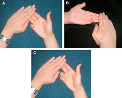 A new test is proposed which can test all the four fds tendons simultaneously. Agenesis Functional Deficiency And The Common Type Of The Flexor Digitorum Superficialis Of The Little Finger A Meta Analysis Sciencedirect