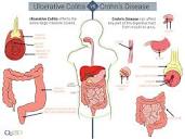 Differences Between Crohn's and Colitis | Qu IBD