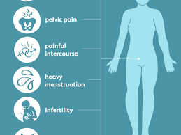 Carlo bulletti, maria elisabetta coccia, silvia battistoni, andrea borini / endometriosis. Symptoms Of Endometriosis
