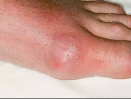 Image result for gout symptoms toe