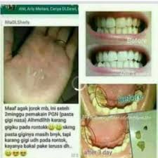 Sakit gigi dan bengkak yang sering dialami banyak orang biasanya jika gigi berlubang sudah lama dan tidak segera ditangani. Pasta Gigi Nasa Atasi Sakit Gigi Gusi Ngilu Karang Gigi Ji Shopee Indonesia