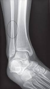 Backpacking Injury Joan West S Collection Of 20 Stress Fracture Ideas
