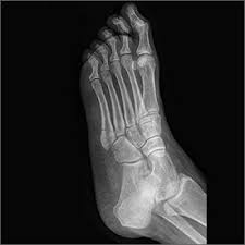 So how do i help a my broken bone heal faster? Adult Foot Fractures A Guide Clinician Reviews