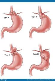 Medscape Log In Gerd Side Effects Cardio Fitness Challenge