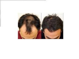 And that's how i came to know that once you start to look­, there are solutions in so many corners of your world. Total Hair Loss Solutions In Leeds Read 8 Reviews