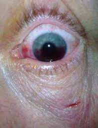 Image result for Hyphema