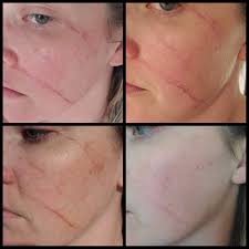 Natural remedies for scar healing after surgery