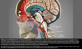 When Persistent Post Concussion Syndrome Turns Into A Neurologic Mystery Caring Medical Florida