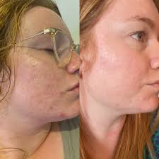 Transdermal Skin Care