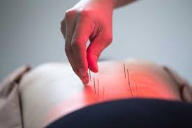Is acupuncture covered by health insurance. Acupuncture Some Points To Ponder Rocky Mountain Health Plans Blog