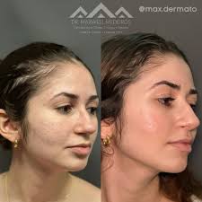 Dr. José Maxwell Medeiros Souza (@max.dermato) • Instagram photos and videos