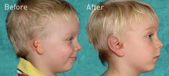 Grade 3 Gallery Microtia Ear Surgery Surgery Ear Plastic Surgery