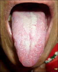 Image result for Fissured tongue