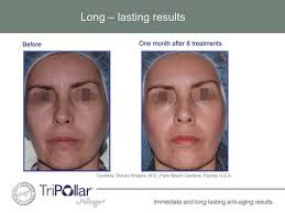 Ultherapy: The First-ever, FDA- approved, Noninvasive, Skin-lifting  Procedure