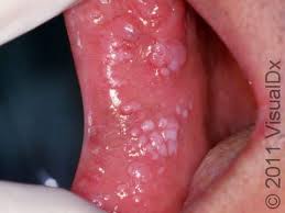 Image result for genital warts