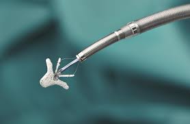 Mitraclip's story starts in california in the late 1990s. Mitral Valve Clip Premier Healthcare Germany