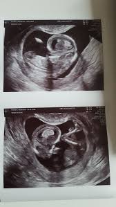 Tell them you paid a scammer with the gift card and ask if they can refund your money. Baby Too Curled Up For Dating Scan Nts March 2020 Babies Forums What To Expect
