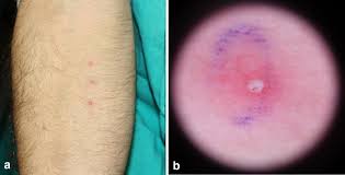 Image result for Pathergy