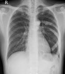 Melorheostosis Also Known As Leri Disease Is An Uncommon Mesenchymal Dysplasia Manifesting As Regions Of Sclerosing Bone Wi With Images Radiology Imaging Radiology X Ray