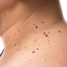 Las 25 enfermedades dermatológicas más comunes Acrocordones Hospital Fuensanta Madrid