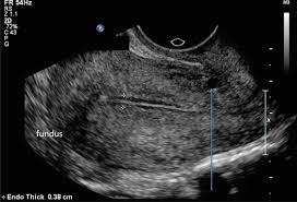 A pelvic ultrasound allows quick visualization of the female pelvic organs and structures including the uterus, cervix, vagina, fallopian tubes and ovaries. Ultrasound Imaging Of Gynaecologic Organs Springerlink