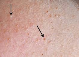 First, there's keratin plugs which are tiny clumps made up of dead keratinocytes, the protein keratin, and the pigment melanin. Disorders Of Sebaceous And Apocrine Glands Fitzpatrick S Color Atlas And Synopsis Of Clinical Dermatology Seventh Edition