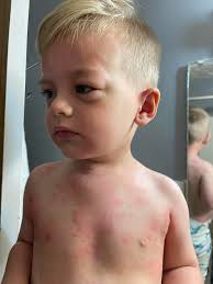 Hi friends, we will be opening late today, if at all. My little guy had a  severe allergic reaction last night and it's still going on. We are headed  to the doctor