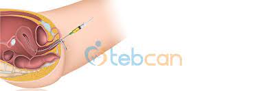 نسبة التوائم في التلقيح الصناعي. Ø­Ù‚Ù†Ø© Ø§Ù„ØªÙ„Ù‚ÙŠØ­ Ø§Ù„ØµÙ†Ø§Ø¹ÙŠ Ø§Ù„Ù…Ù†Ø²Ù„ÙŠ Farizmedia Com