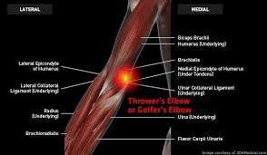 And it's been recognized at least since the 19th century. Thrower S Elbow Or Golfer S Elbow Medial Epicondylitis Medial Elbow Tendinosis Thermoskin Supports And Braces For Injury And Pain Management