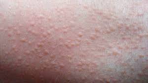 Heat Rash Pictures Remedies And More