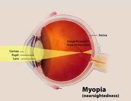 Image result for Refractive Error