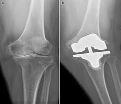 Related online courses on physioplus. Early Femoral Condyle Insufficiency Fractures After Total Knee Arthroplasty Treatment With Delayed Surgery And Femoral Component Revision Sciencedirect