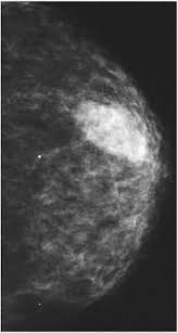 It may also be performed on healthy, normal a routine screening mammogram usually includes at least two pictures of each breast taken at. Mammogram Images And Ultrasound Explained By Moose And Doc