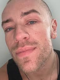 Today marks 1 year since I realised this was no longer just eczema and my  life literally flipped upside down because of a skin condition called  Topical Steroid Withdrawal (TSW). A condition